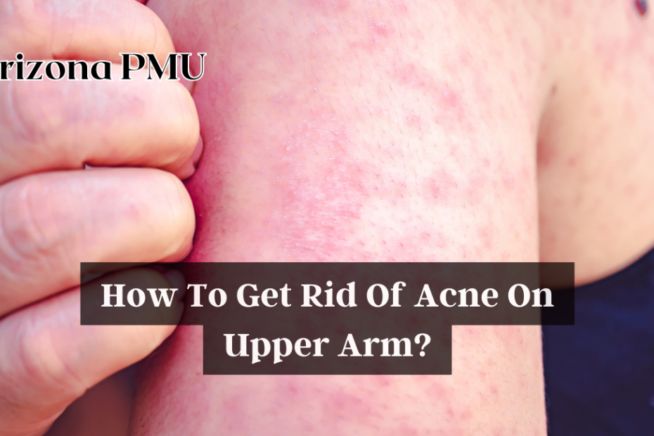 How To Get Rid Of Acne On Upper Arm?