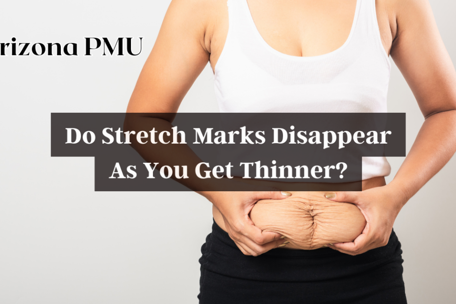 Do Stretch Marks Disappear As You Get Thinner?